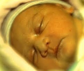 Ictericia: coloración amarilla