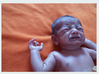 Recién nacido con cianosis