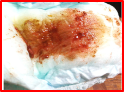 Deposiciones anormales a con sangre b acolicas